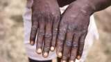 Monkey Pox Guidelines | Central Government Issued Guidelines Regarding Monkey Pox